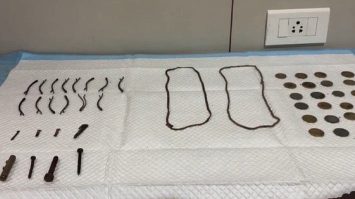Tamil Nadu Doctors Remove 23 Coins, Objects From Teen's Stomach