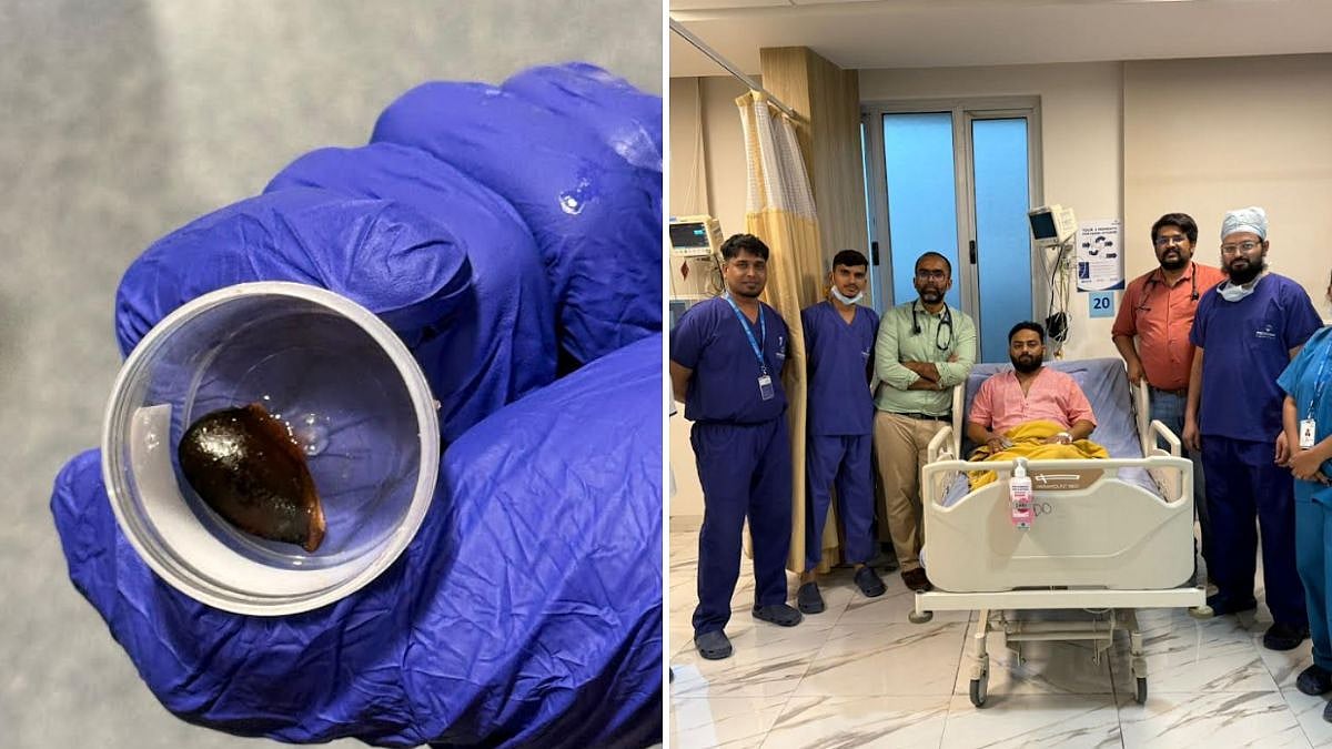 Navi Mumbai Doctors Remove Chikoo Seed From Man's Airway